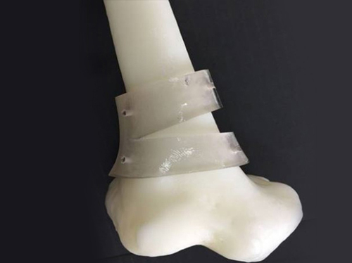 Модель бедренной кости с направляющими для остеотомии, напечатанная на 3D-принтере