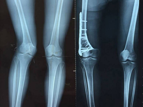 Фотографии перед и после остеотомии, сравнение бедра и ноги пациента до и после проведенной остеотомии